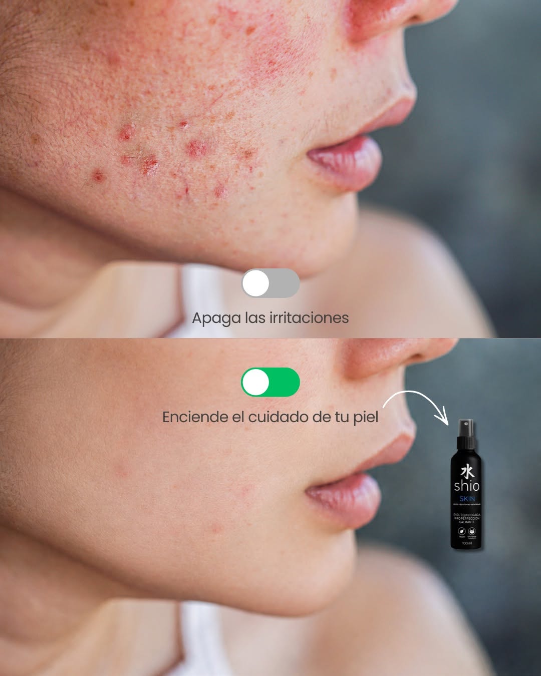  ¿Rosácea o piel sensible? Aprende a diferenciarlas, identifica sus señales y descubre cómo cuidar y proteger tu barrera cutánea sin saturar la piel.
