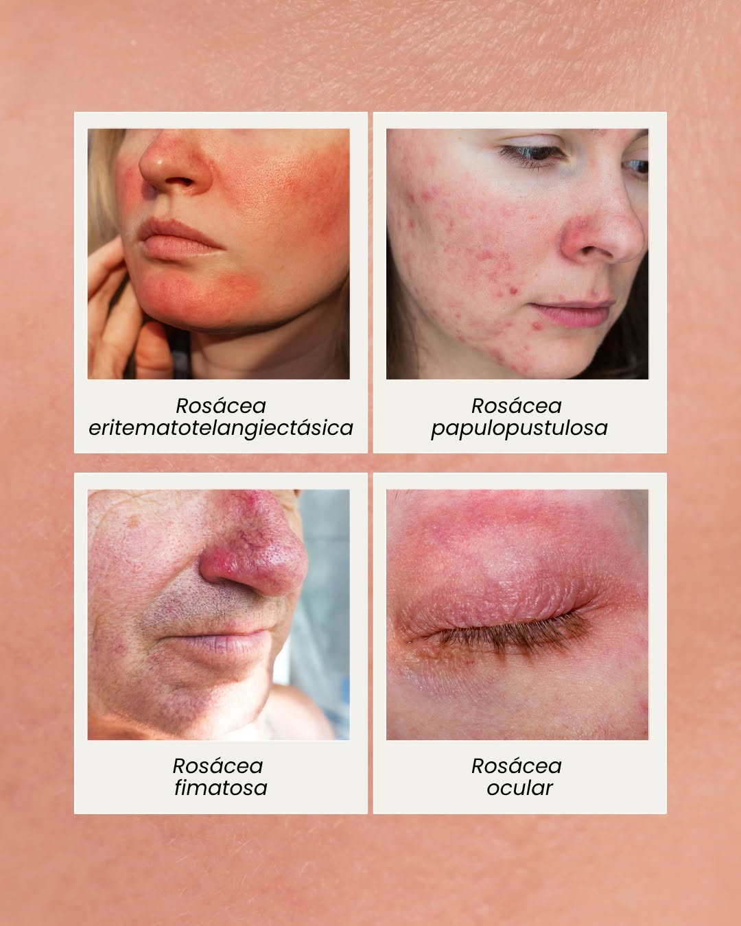 brotes de rosácea | Shio Skin